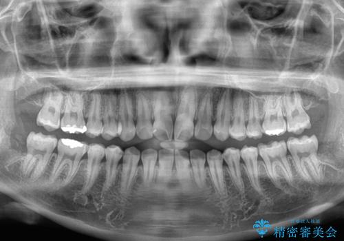 気になる前歯を矯正　短期間のワイヤー矯正治療の治療前