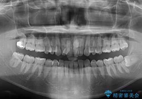 骨格性のディープバイト　補助装置を併用したワイヤー矯正治療で咬み合わせを改善の治療前