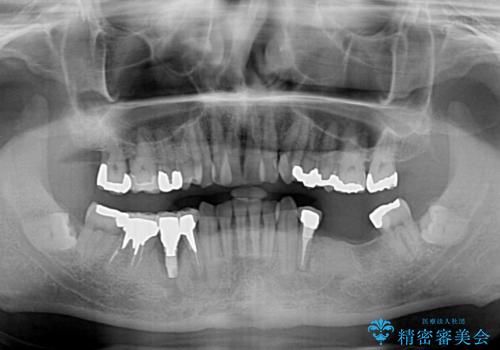 奥歯の欠損と前歯のデコボコを治したい インプラントと矯正治療の総合歯科治療の治療前