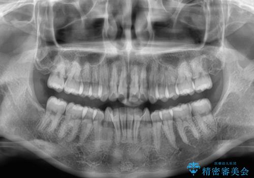 深い咬み合わせによる隙間 インビザライン矯正でコンプレックスを改善の治療前
