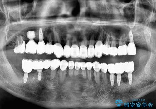強い咬合力で奥歯がボロボロに インプラント治療による咬合回復と全顎セラミック治療の治療後