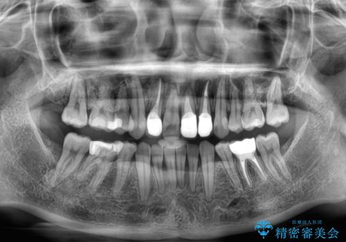 気になっていたむし歯と前歯のデコボコ 矯正治療とむし歯治療の総合歯科治療の治療後