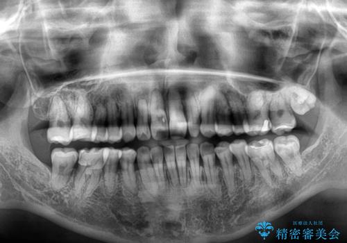 骨格的なズレを歯列矯正でカバー　ワイヤー装置での非抜歯矯正の治療後