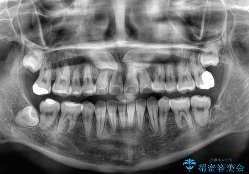 永久歯が埋もれて乳歯が残存 叢生改善のワイヤー抜歯矯正の治療後