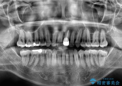 気になる前歯のデコボコと八重歯　ワイヤー矯正ですっきりとの治療後