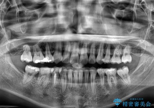 矯正治療の後戻り インビザラインで短期間矯正治療の治療後