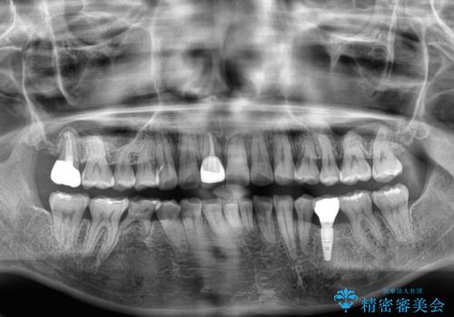 デコボコと乳歯の欠損 ワイヤー矯正とインプラント補綴治療の治療後