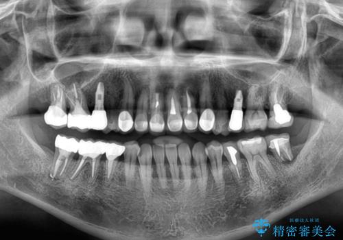 新幹線通院 地元で断られた奥歯のむし歯治療の治療後