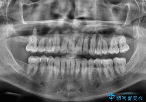 インビザラインは煩わしい ワイヤー矯正で短期間矯正治療の治療後