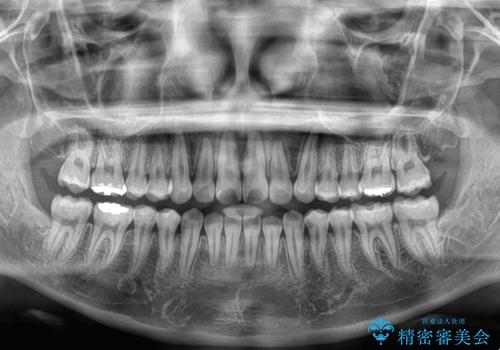 気になる前歯を矯正 短期間のワイヤー矯正治療の治療後