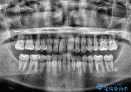骨格性のディープバイト　補助装置を併用したワイヤー矯正治療で咬み合わせを改善の治療後