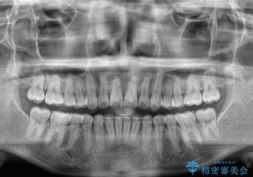 深い咬み合わせによる隙間 インビザライン矯正でコンプレックスを改善の治療後