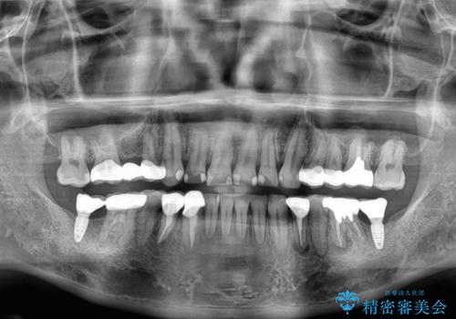 銀歯を白くしたい 一緒に矯正治療も行ない美しい口腔内にの治療後