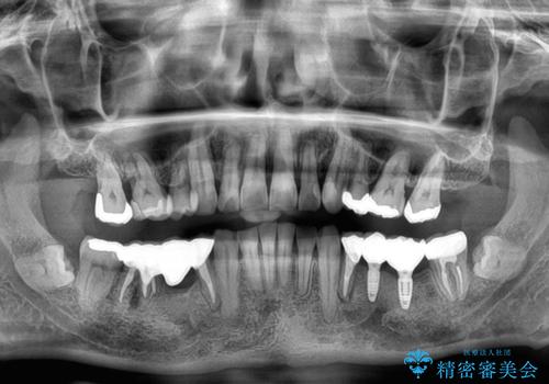 奥歯の欠損と前歯のデコボコを治したい インプラントと矯正治療の総合歯科治療の治療後