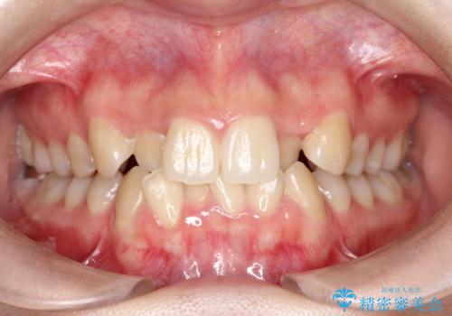 目立たない矯正で歯のデコボコと反対咬合を改善の症例 治療前