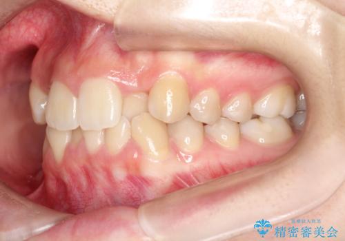 目立たない矯正で歯のデコボコと反対咬合を改善の治療前