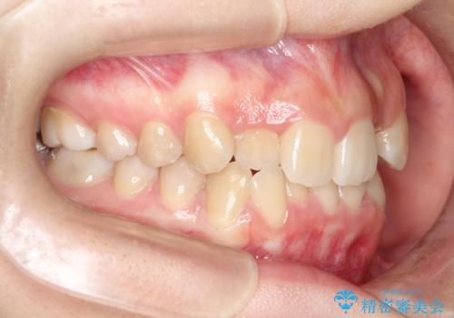 目立たない矯正で歯のデコボコと反対咬合を改善の治療前