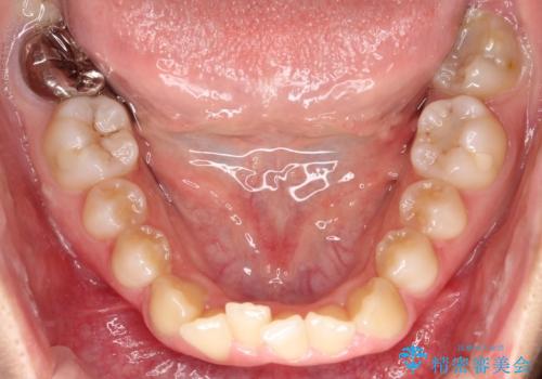 目立たない矯正で歯のデコボコと反対咬合を改善の治療前