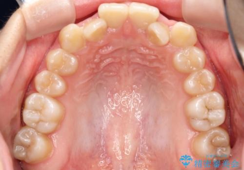 目立たない矯正で歯のデコボコと反対咬合を改善の治療前