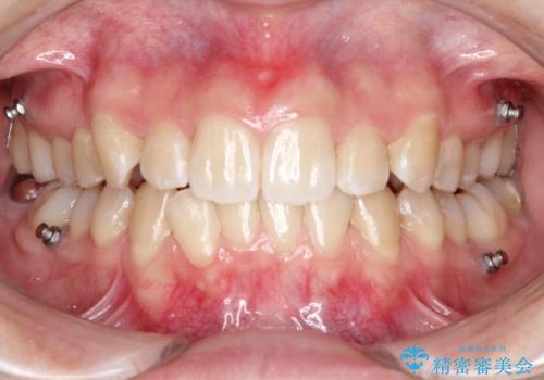 目立たない矯正で歯のデコボコと反対咬合を改善の治療中