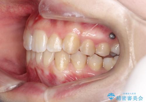 目立たない矯正で歯のデコボコと反対咬合を改善の治療中