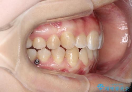 目立たない矯正で歯のデコボコと反対咬合を改善の治療中