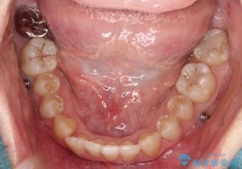 目立たない矯正で歯のデコボコと反対咬合を改善の治療中