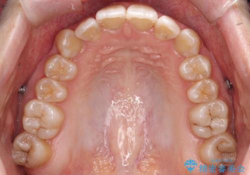 目立たない矯正で歯のデコボコと反対咬合を改善の治療中