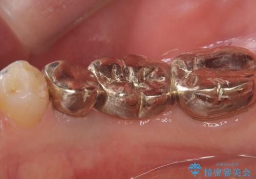 【ゴールドクラウン】セラミックのブリッジが何度も壊れるの治療後