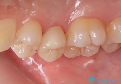 【根管治療】【セラミッククラウン】根っこが細くて治療できないと言われたの治療後