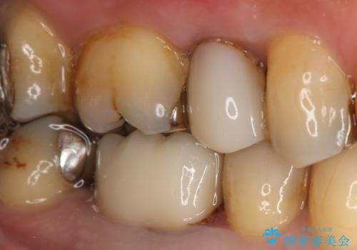 奥歯が痛む オールセラミッククラウンの治療前