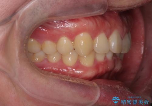 下の歯のがたつきが気になる。 インビザラン&ワイヤー部分矯正併用の治療前