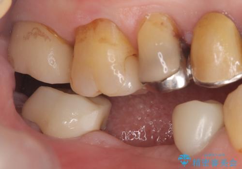 【ゴールドクラウン】セラミックのブリッジが何度も壊れるの治療前