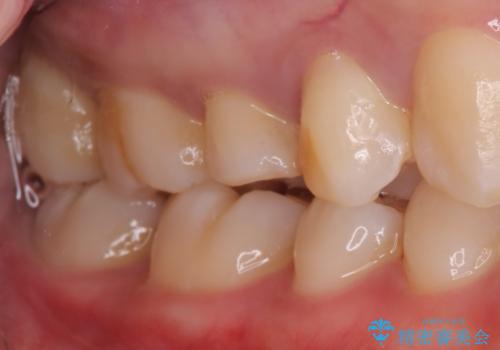 【根管治療】【セラミッククラウン】根っこが細くて治療できないと言われたの治療前