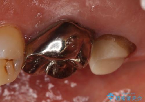奥歯が取れた フルジルコニアクラウンの治療中