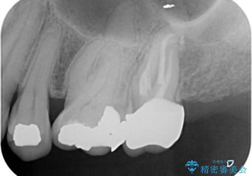 銀歯を白くしたいセラミック治療。の治療後