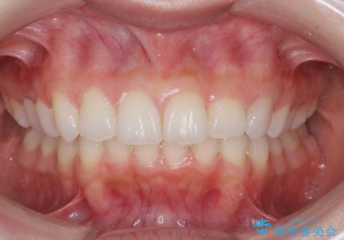 前歯のがたつき気になる。インビザラインモデレートの治療後