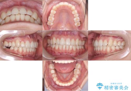 非抜歯矯正で八重歯を改善|短期間8か月で美しい歯並びに|インビザラインライト上顎のみで矯正の治療後