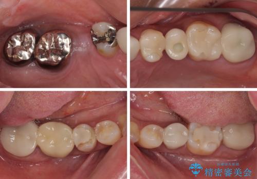 新幹線通院 地元で断られた奥歯のむし歯治療の治療前