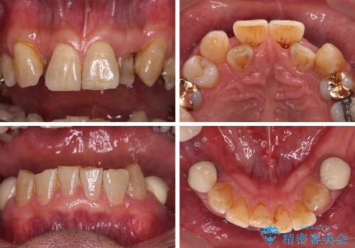 奥歯の欠損と前歯のデコボコを治したい インプラントと矯正治療の総合歯科治療の治療前