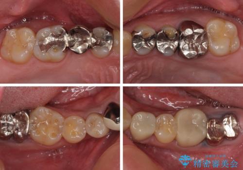 銀歯を白くしたい 一緒に矯正治療も行ない美しい口腔内にの治療前