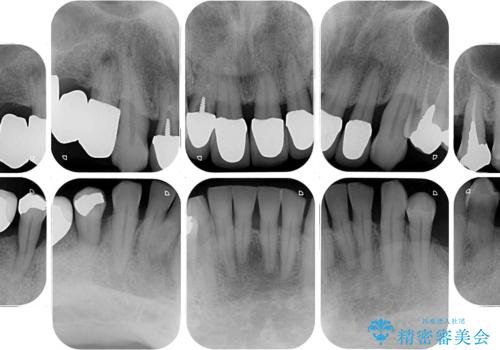 強い咬合力で奥歯がボロボロに インプラント治療による咬合回復と全顎セラミック治療の治療前