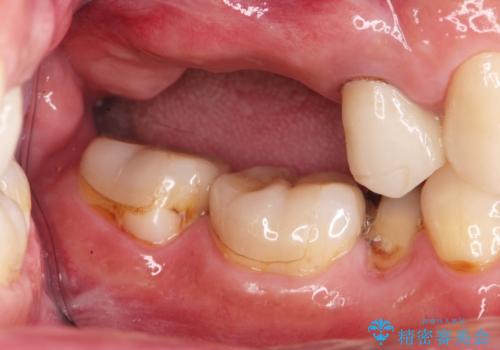 欠損した奥歯 インプラント補綴の治療前
