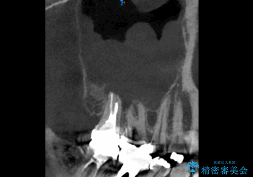 右奥歯治療が必要と言われた。の治療前