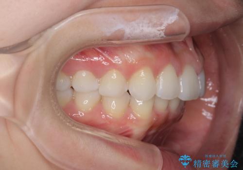 前歯のがたつき気になる。インビザラインモデレートの治療後