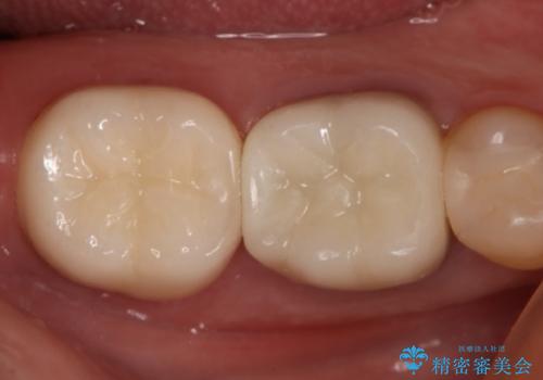 奥歯が痛む オールセラミッククラウンの治療後