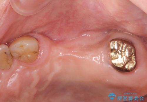 入れ歯では食事を楽しめない。インプラントによる咬合機能回復の治療前