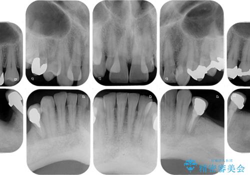 奥歯の欠損と前歯のデコボコを治したい インプラントと矯正治療の総合歯科治療の治療前