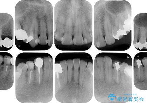 銀歯を白くしたい 一緒に矯正治療も行ない美しい口腔内にの治療前