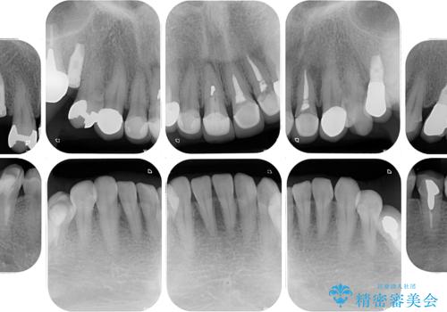 新幹線通院 地元で断られた奥歯のむし歯治療の治療前